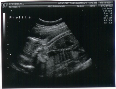Baby 2004: Ultrasound